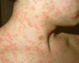 rashes